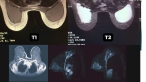 T1 vs T2 breast MRI scan