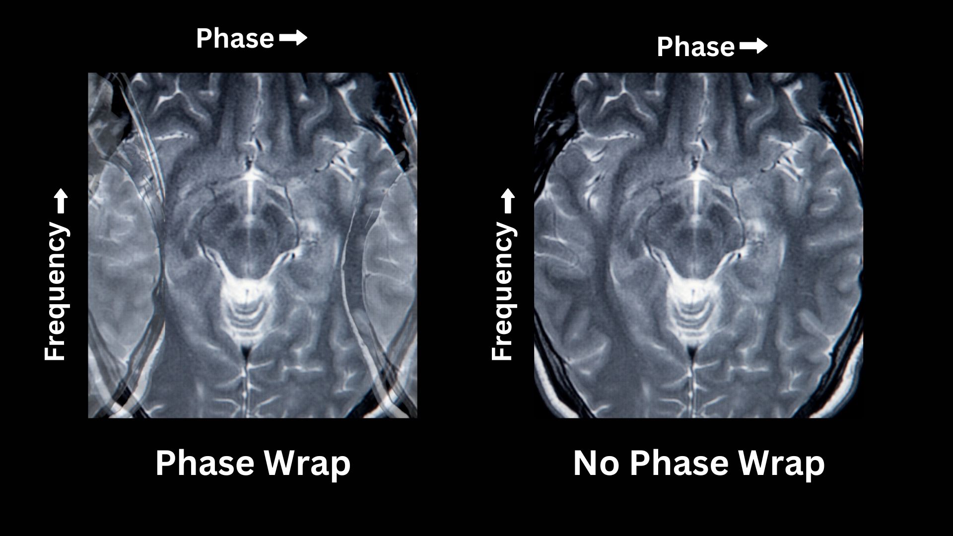 GE MRI no phase wrap imaging option brain scan axial view. vs phase wrap artifact