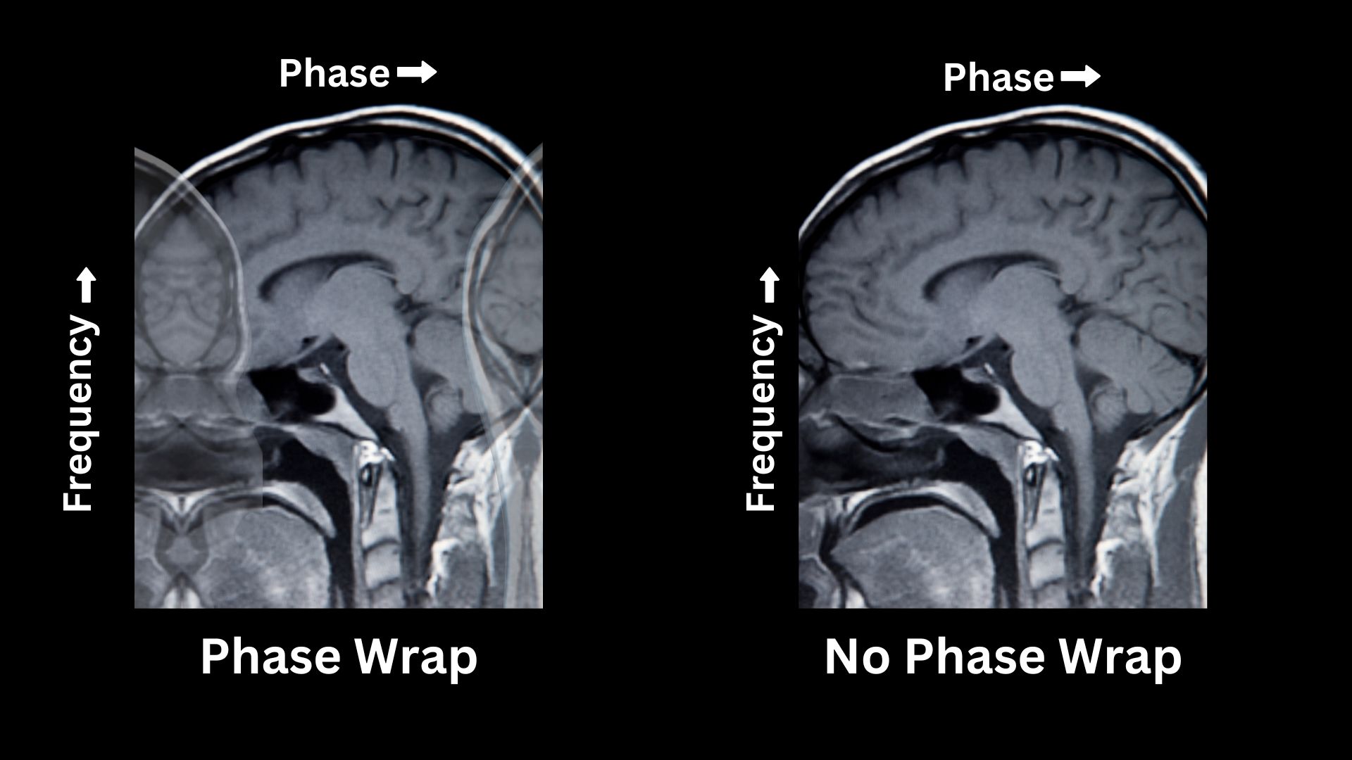 ge mri no phase wrap vs phase wrap brain sagittal view phase wrap artifact MRI scan