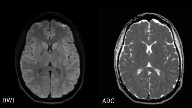 dwi mri vs adc mri, dwi vs adc, dwi, adc mri