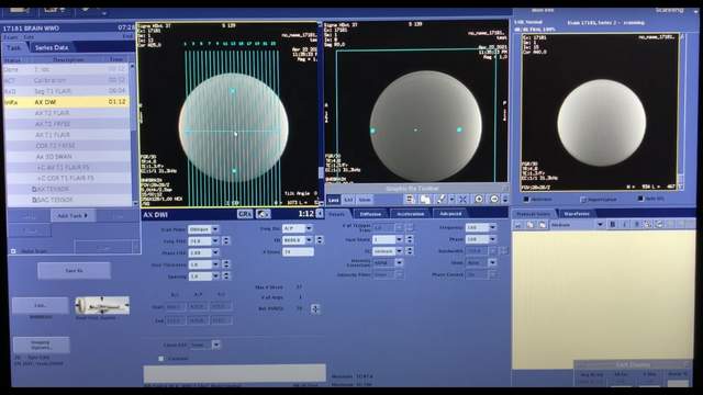 dwi mri scan protocol setup