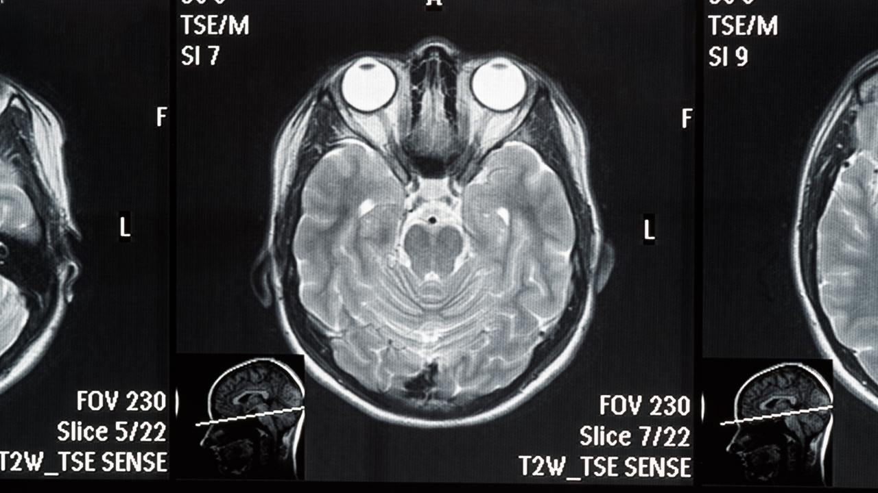 t2 weighted mri scan, mri scan parameters